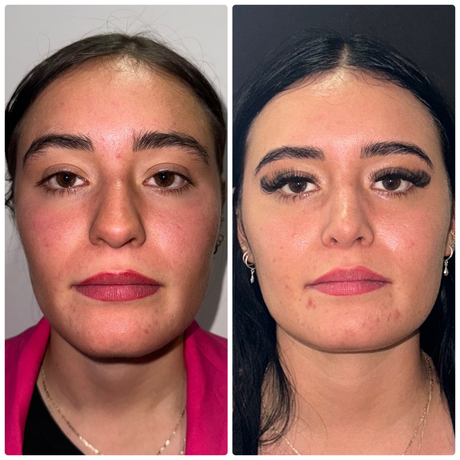 antes-y-despues-de-rinoseptoplastia-en-paciente-con-tabique-desviado