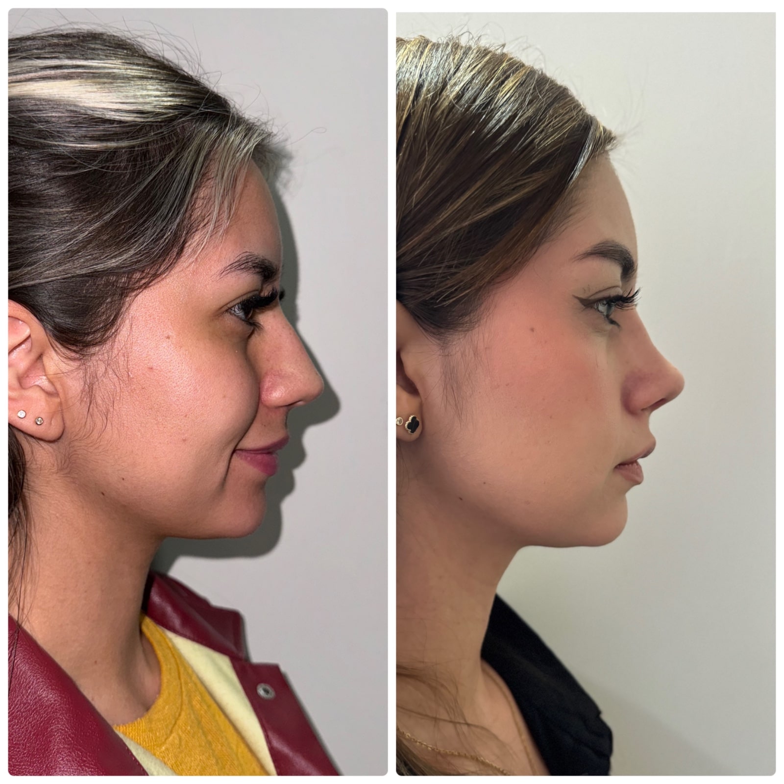 rinoplastia-ultrasonica-en-mujer-con-nariz-torcida-resultados-armonicos