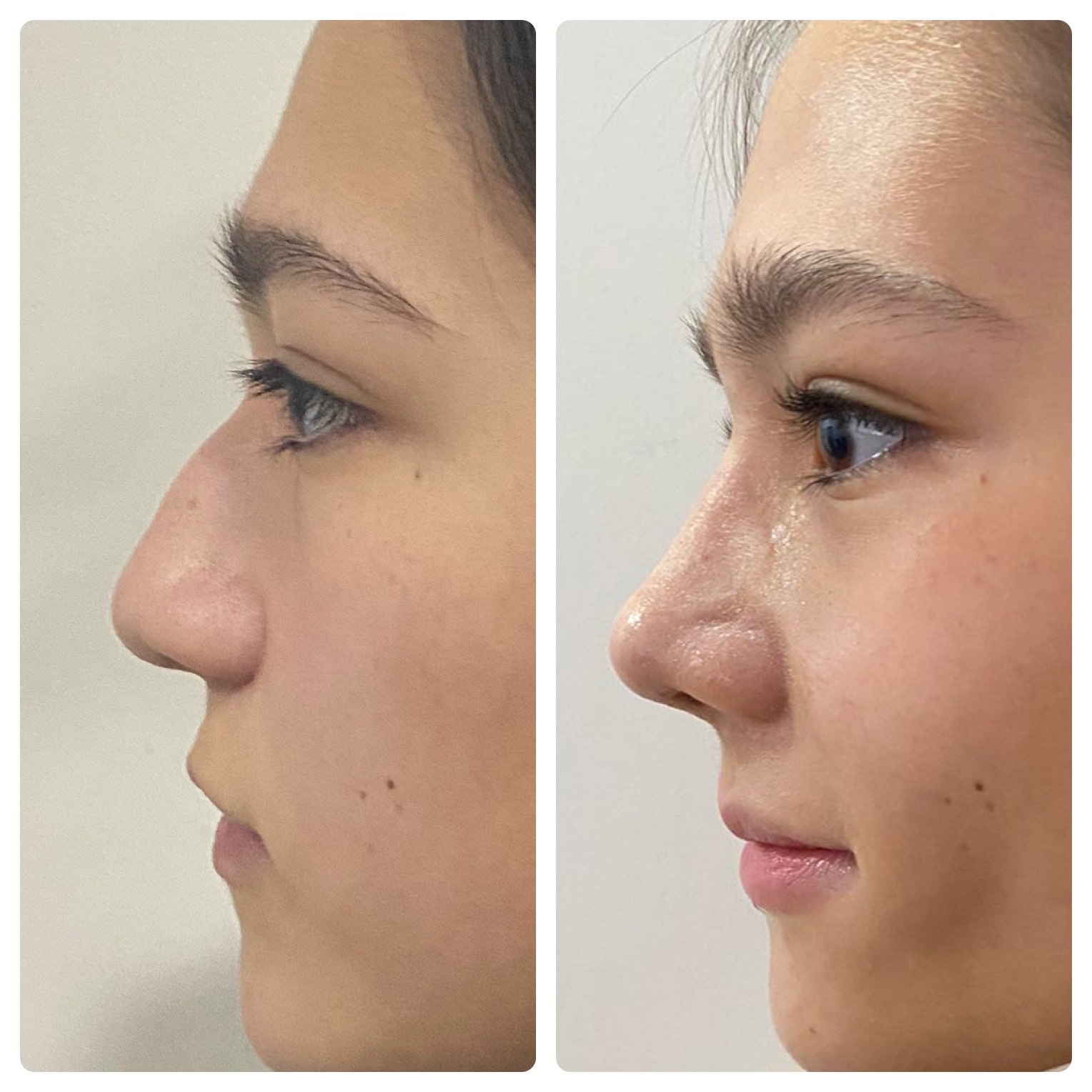 perfil-nasal-antes-y-despues-de-rinoplastia-ultrasonica-en-chihuahua