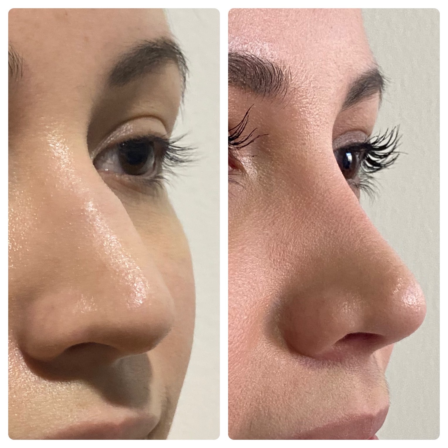 nariz-armonica-post-rinoplastia-ultrasonica-en-mujer-con-perfil-sutil
