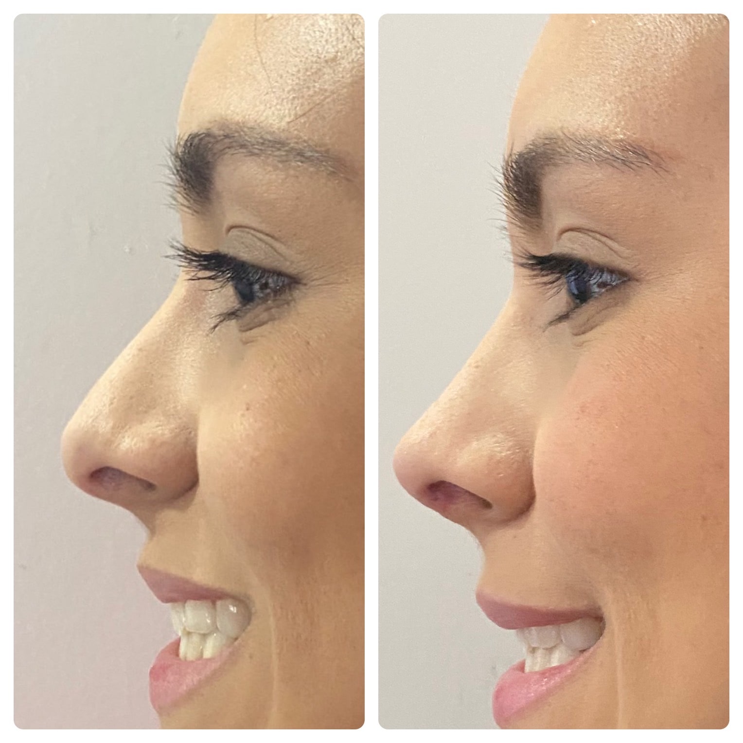 antes-y-despues-de-rinoplastia-natural-en-mujer-joven-chihuahua