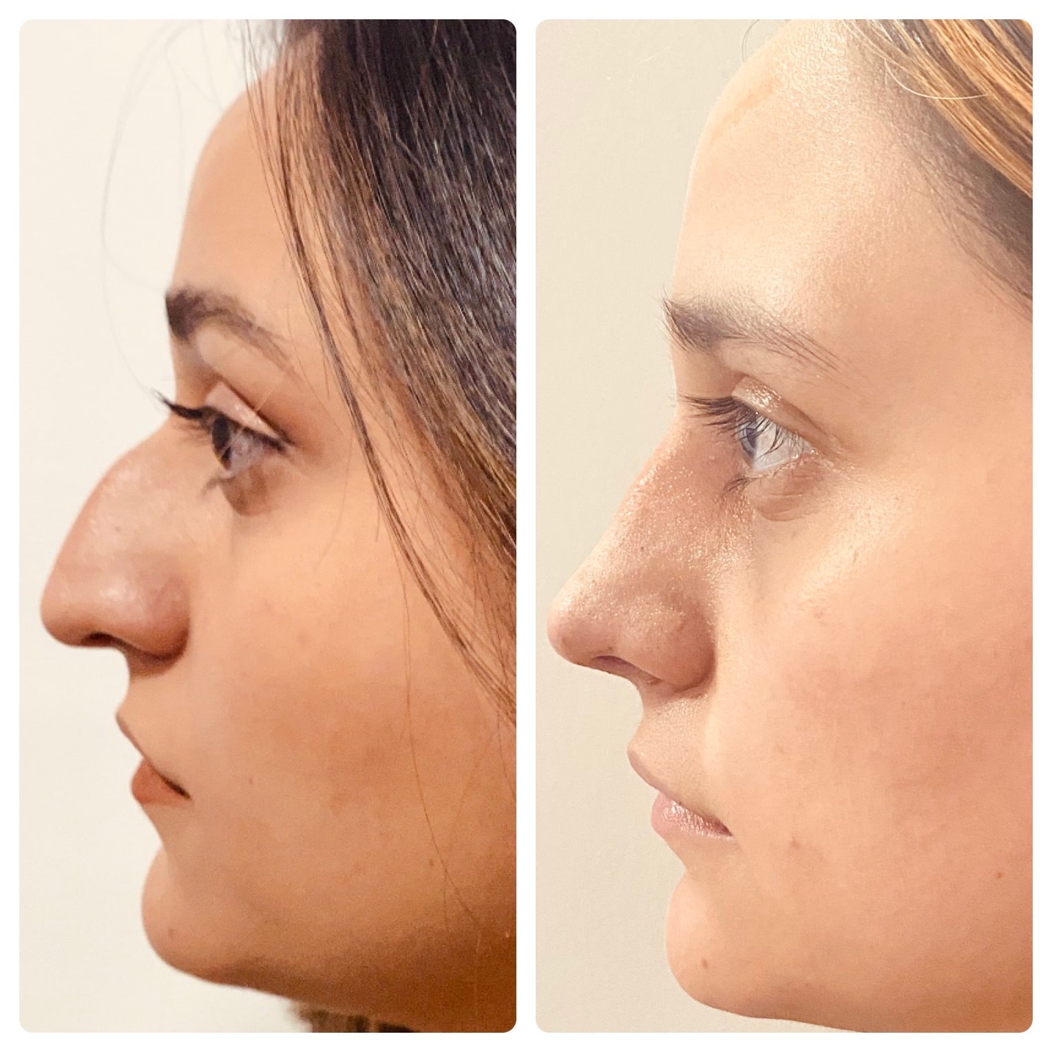 rinoplastia-ultrasonica-con-reduccion-de-giba-nasal-en-chihuahua