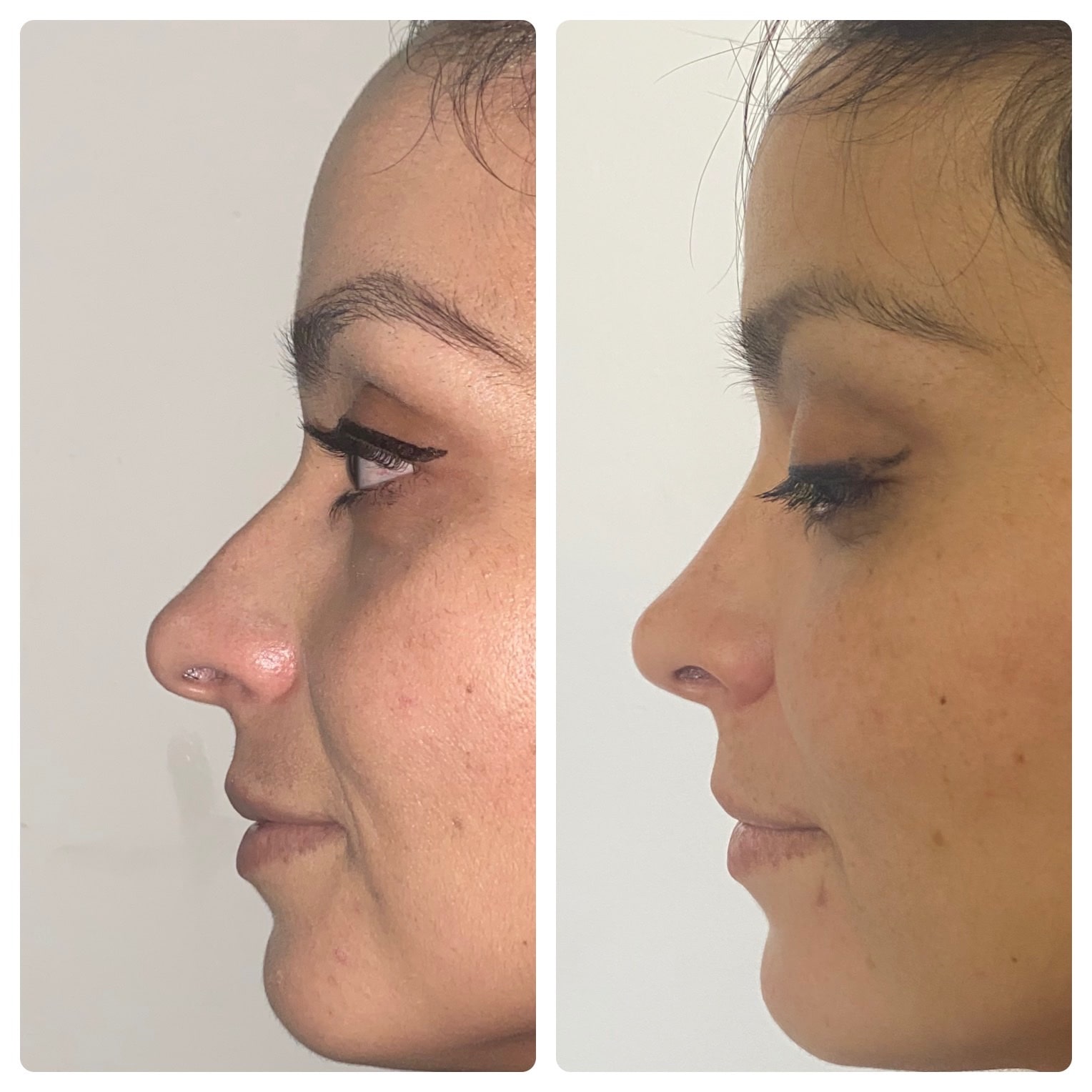 mejora-de-simetria-nasal-con-rinoplastia-en-hombre-joven-chihuahua
