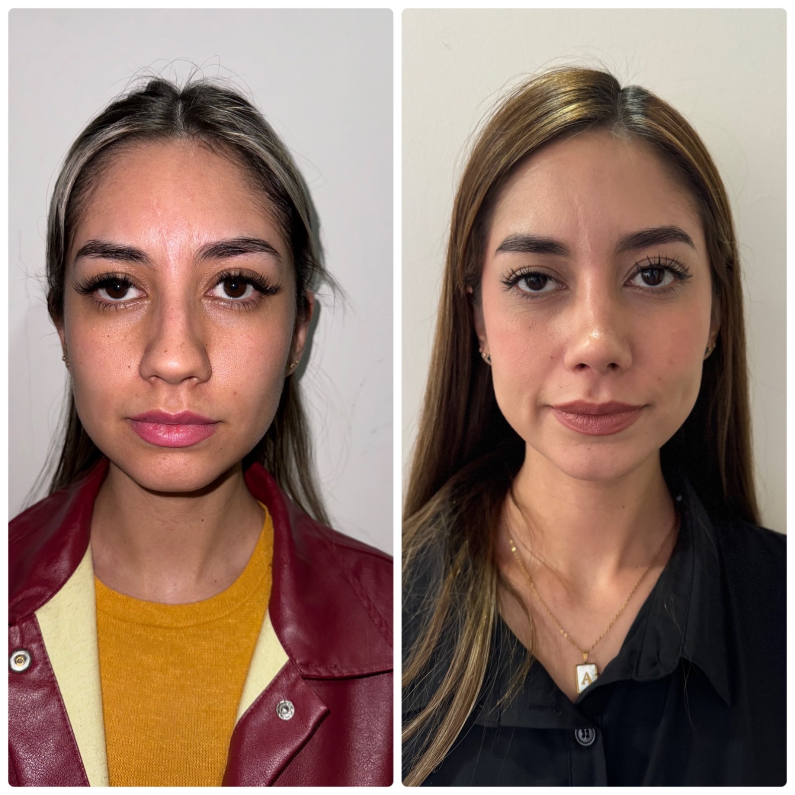 mejora-de-la-funcion-respiratoria-y-estetica-post-rinoplastia