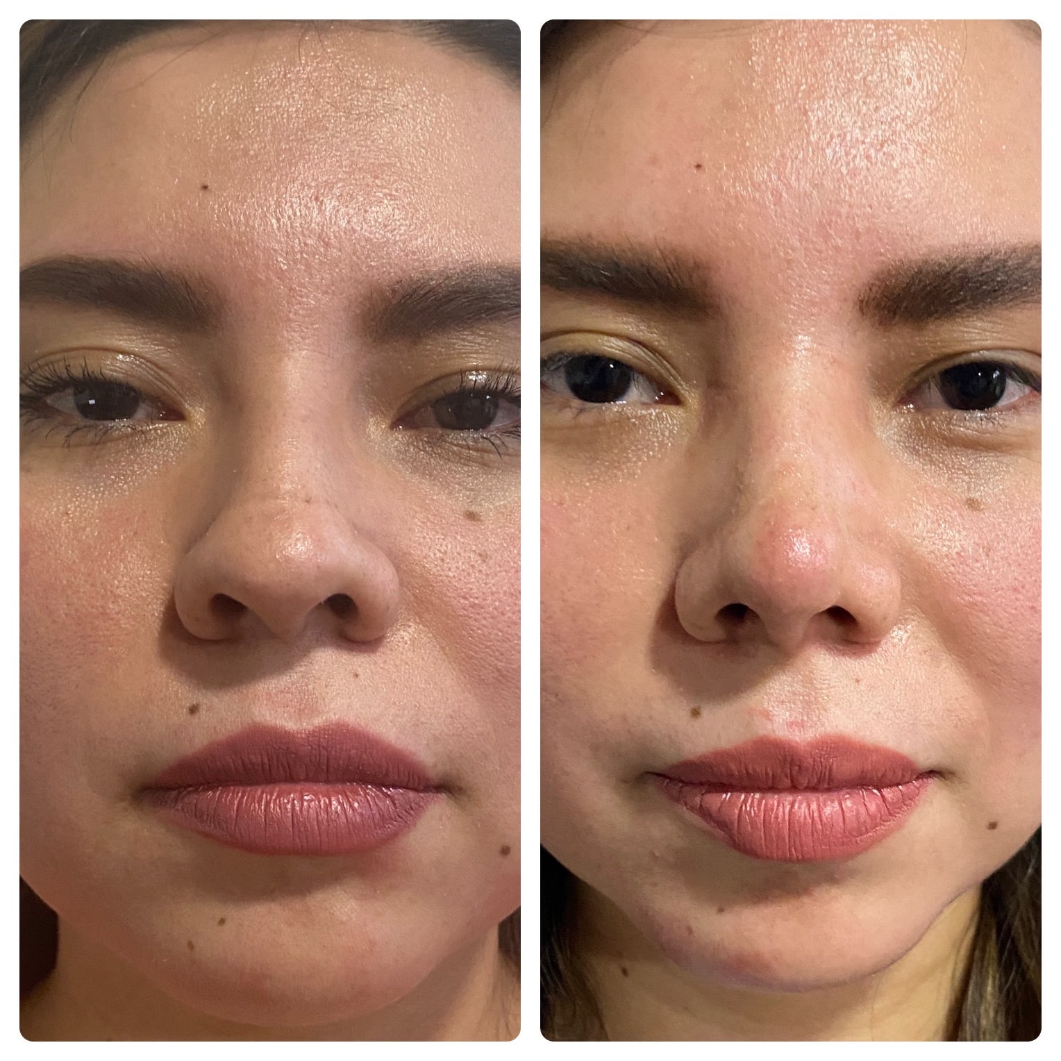 resultado-de-rinoplastia-natural-con-enfoque-estetico-y-funcional