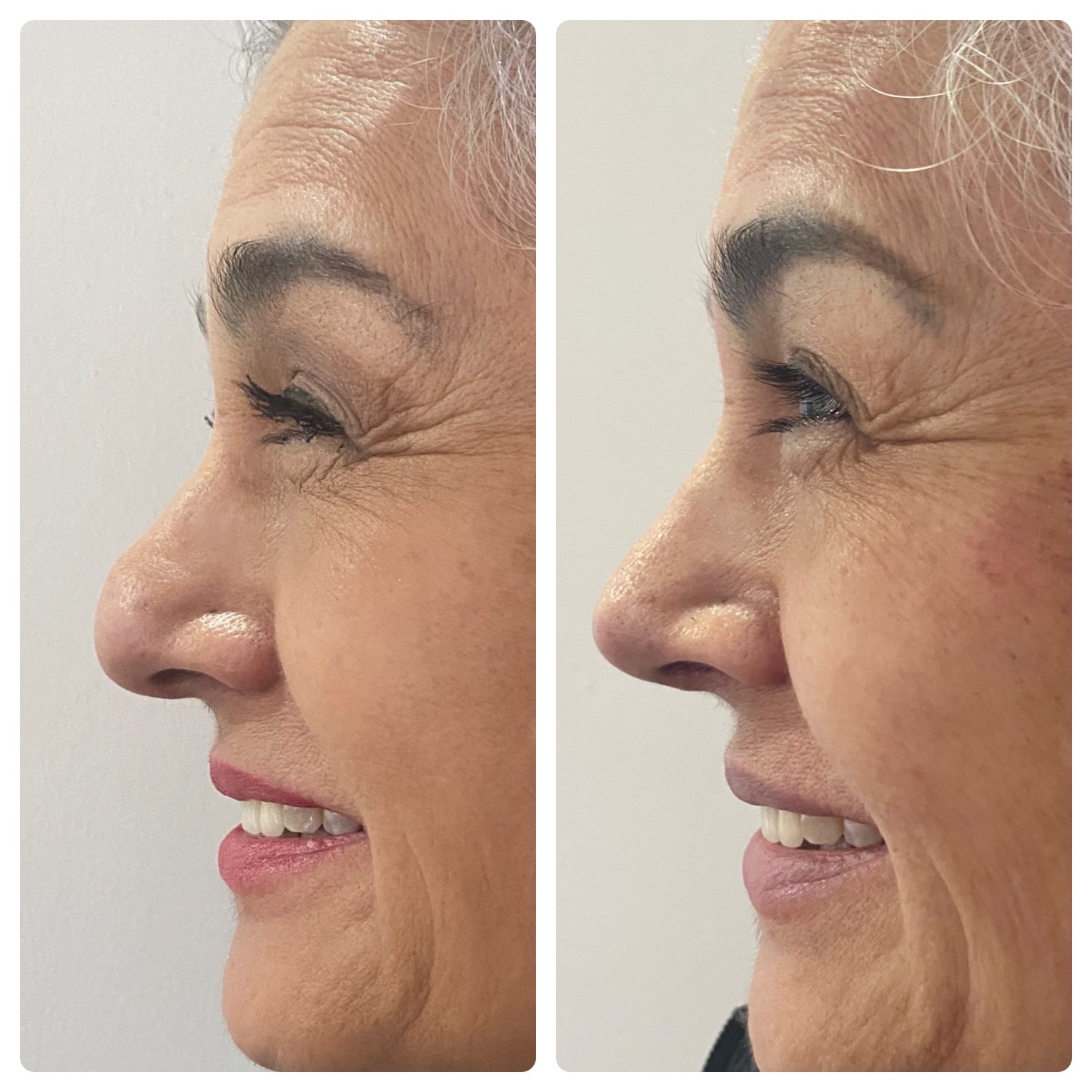 cambio-en-la-punta-nasal-despues-de-rinoplastia-en-paciente-femenina