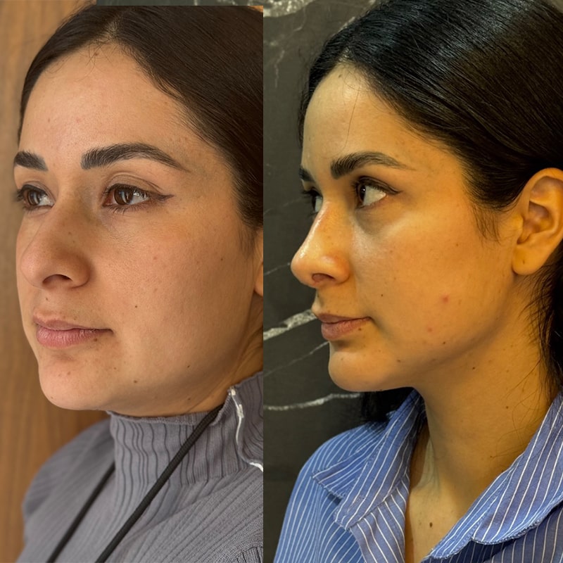 comparativa-frontal-antes-y-despues-de-rinoplastia-en-chihuahua
